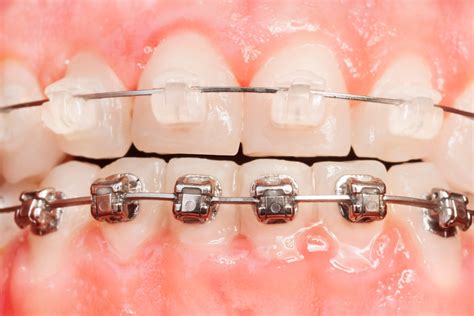 diferencia brackets metalicos y esteticos|brackets autoligados.